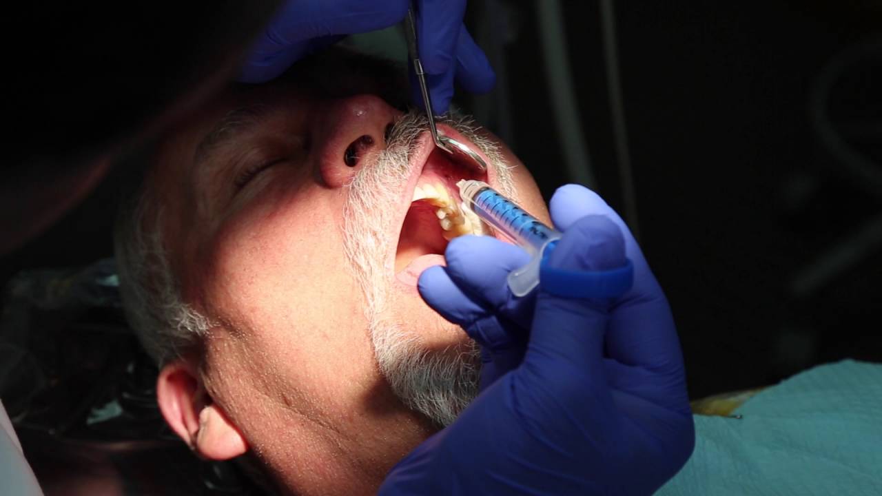 My Technique: How I Use Anutra for a Palatal Infiltration