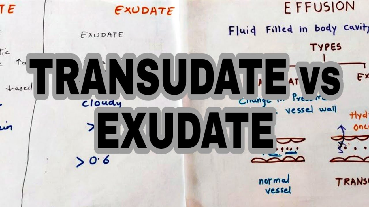 Transudate vs Exudate | Types of effusion | light's criteria