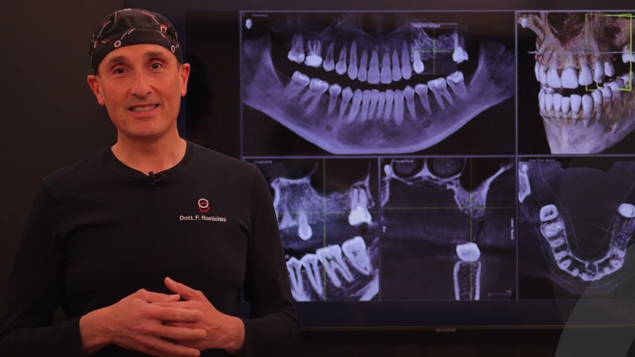 Vantaggi della Radiologia Digitale in ambito dentale - Dr Filippo Rustichini Odontoiatra