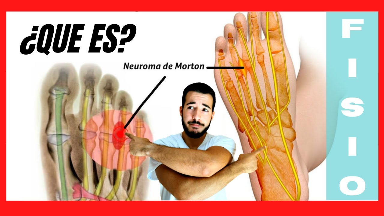 &iquest;Qu&eacute; es el Neuroma de Morton y Qu&eacute; lo Produce? 🦶🏼 EVITALO!!!