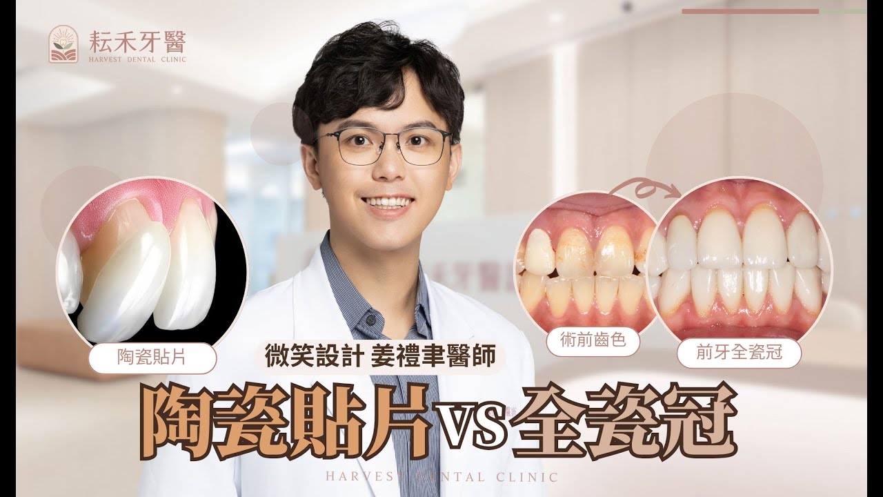 陶瓷貼片與全瓷冠的差異? | 微笑設計 姜禮聿醫師