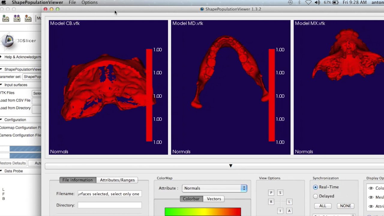 5A 3D Craniofacial Quantification of Changes-Compute the Surface Distances using a Color Map