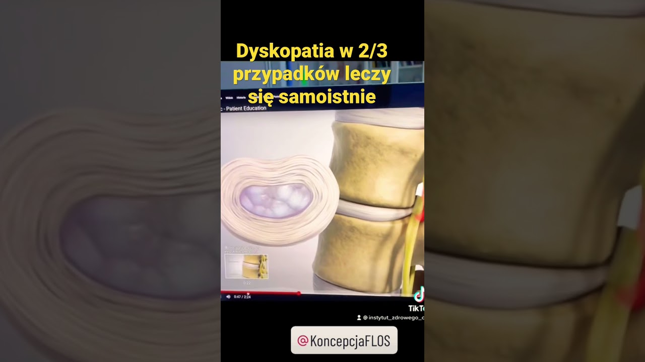 Dyskopatia w 2/3 przypadk&oacute;w leczy się samoistnie - wskazuje metaanaliza z 2017r #kręgosłup