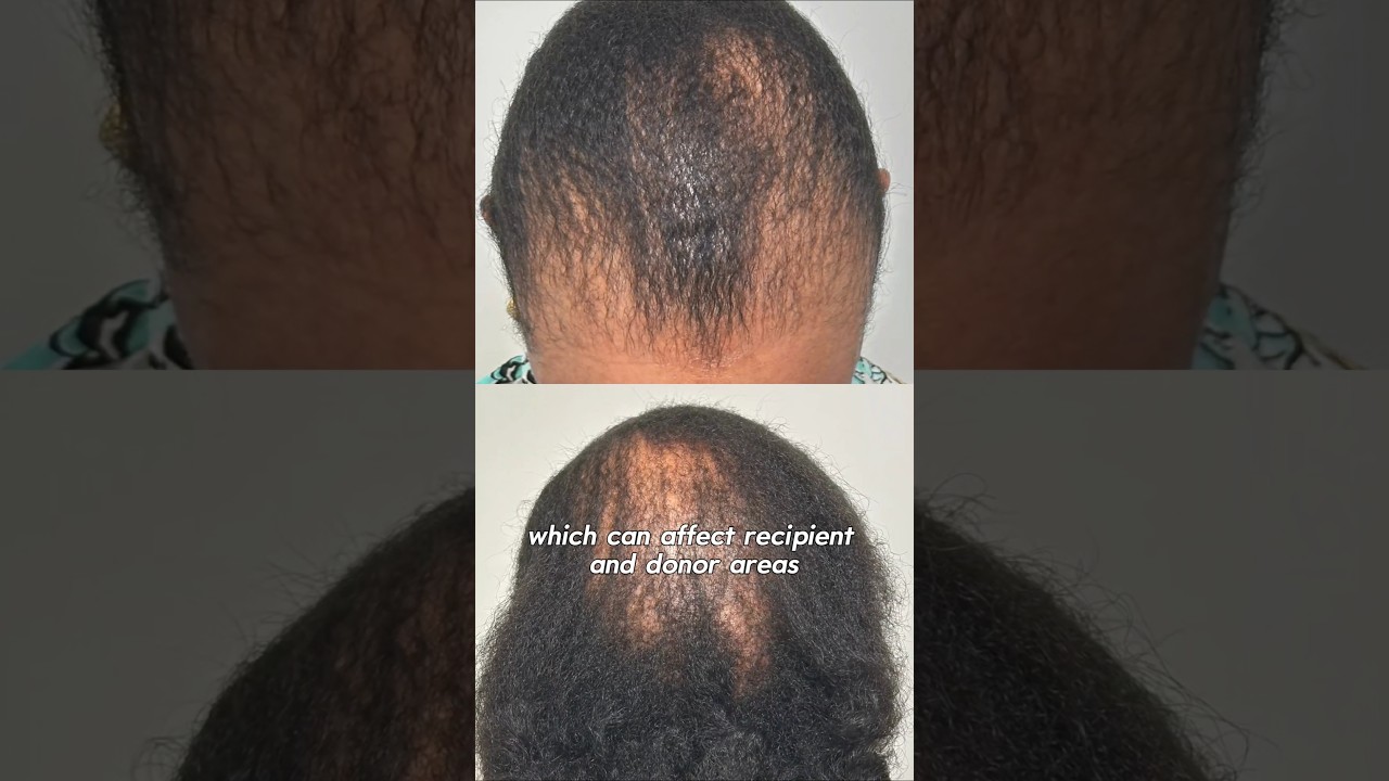 Hair Transplant Patient With CCCA. #hairtransplant #surgeon #ccca #alopecia