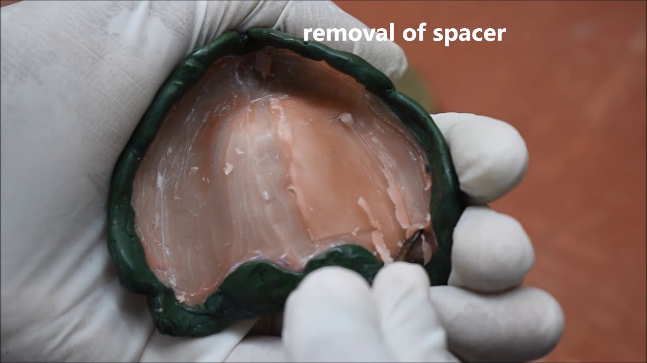 Final Impression using selective pressure impression technique