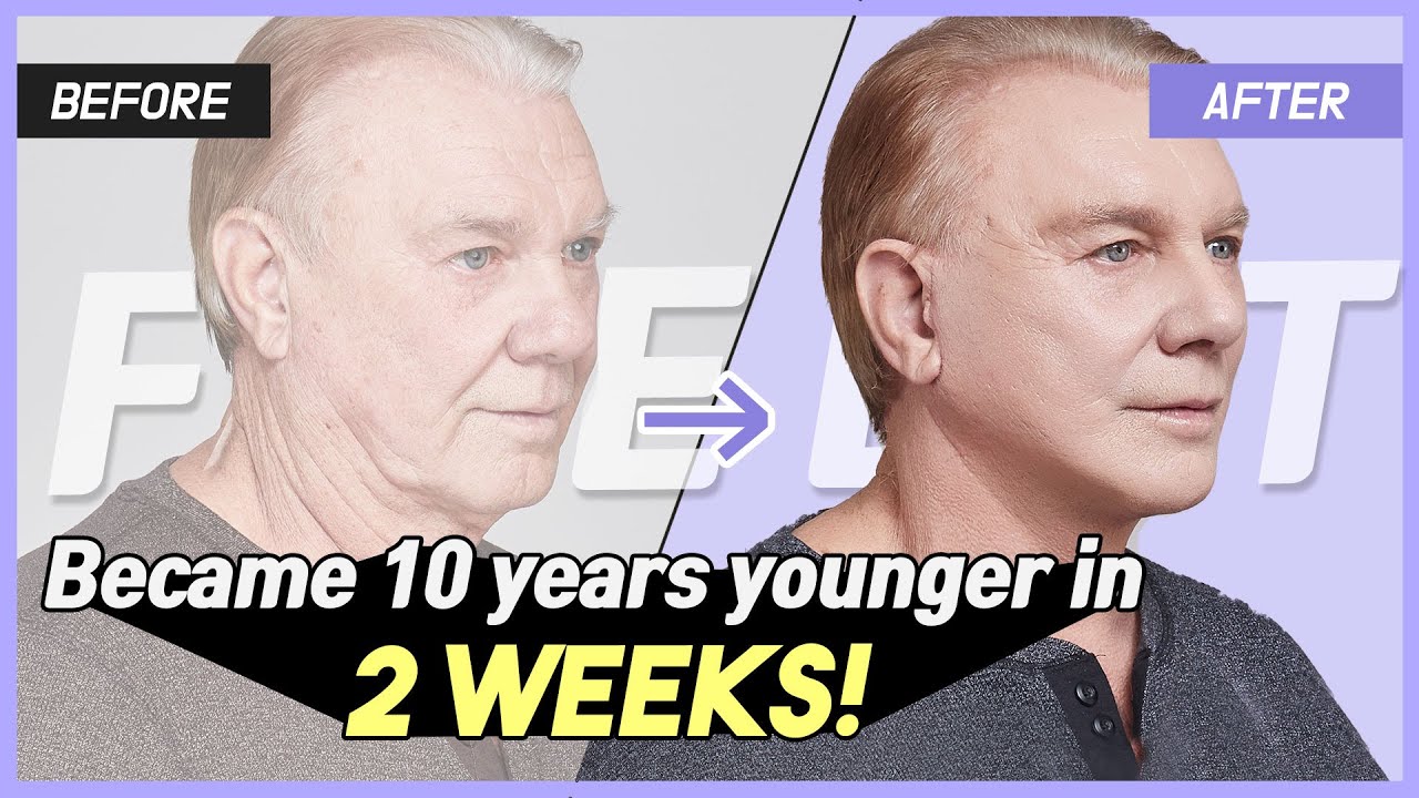 Paul's Korean Plastic Surgery experience - Face lift, Neck lift, and Rhinoplasty