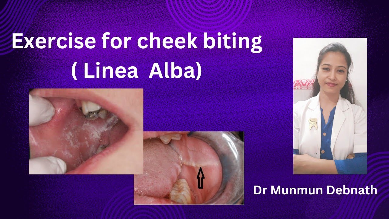 Exercise for cheek biting (Linea Alba) #awareness for oral health@dr.munmundebnath