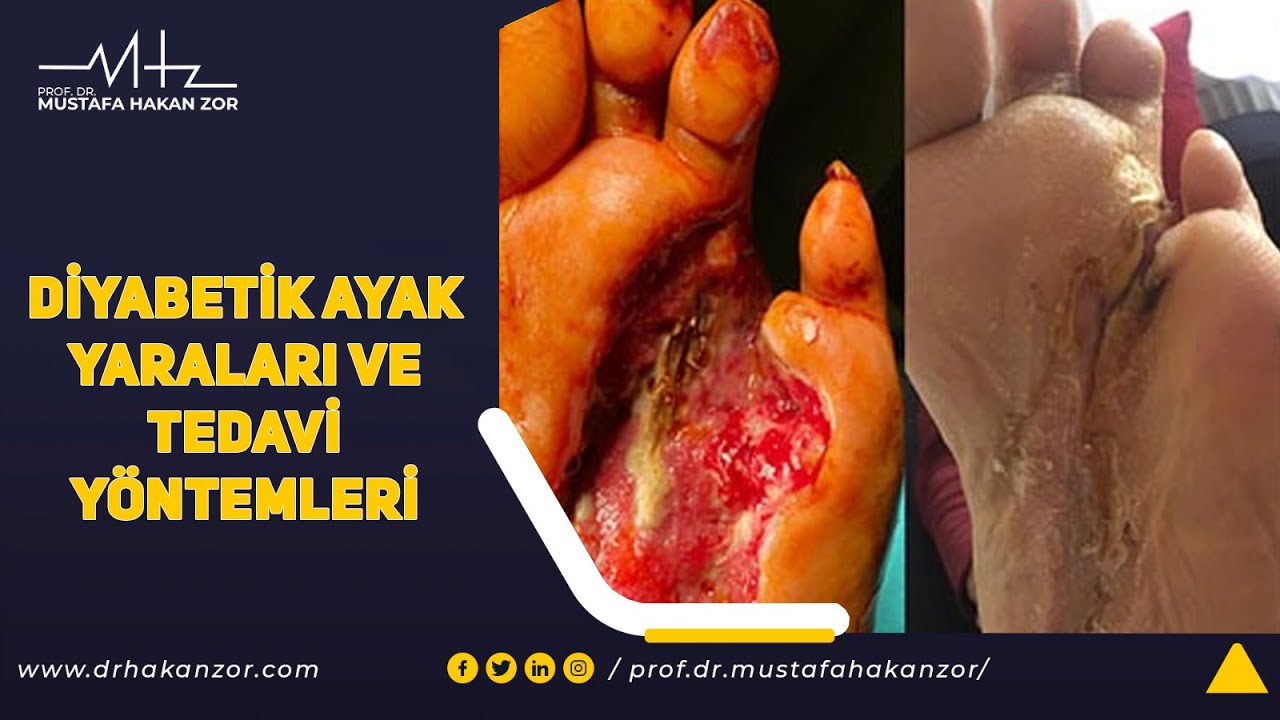 Diyabetik Ayak Yaraları Nedir ve Nasıl Tedavi Edilir?