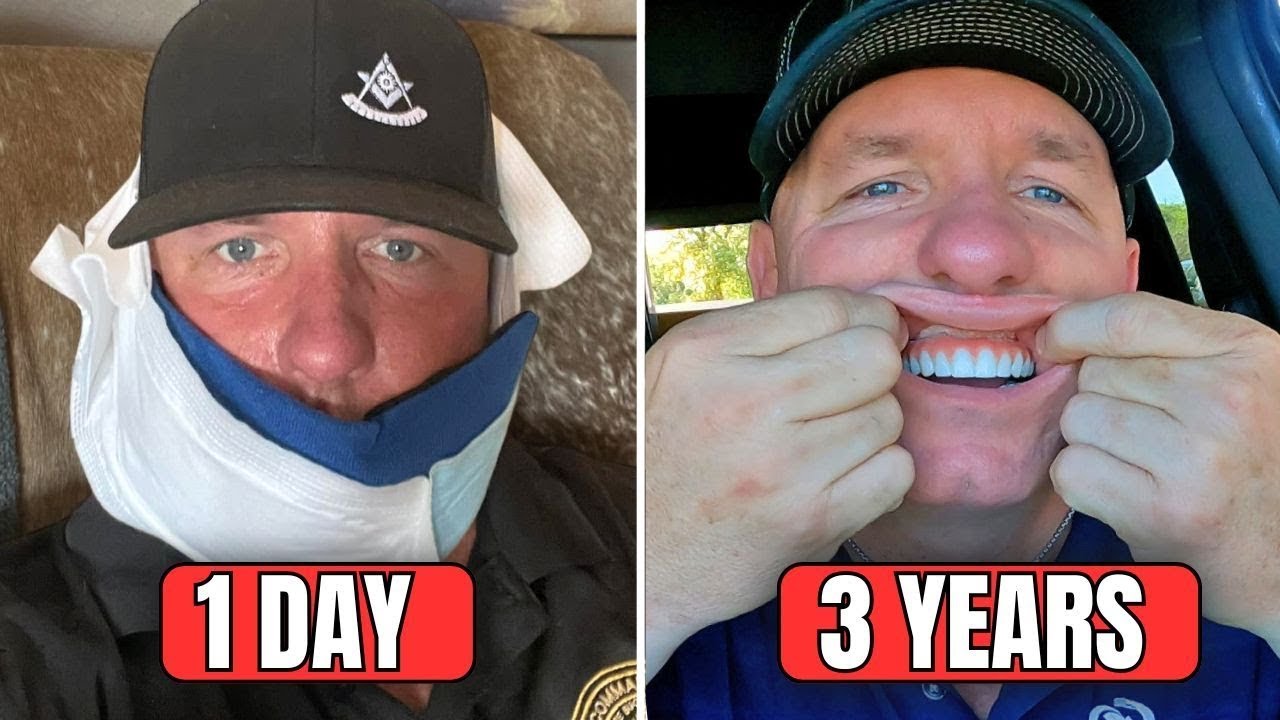 How Do Dental Implants REALLY Feel? Day 1 vs. 3 Years Later