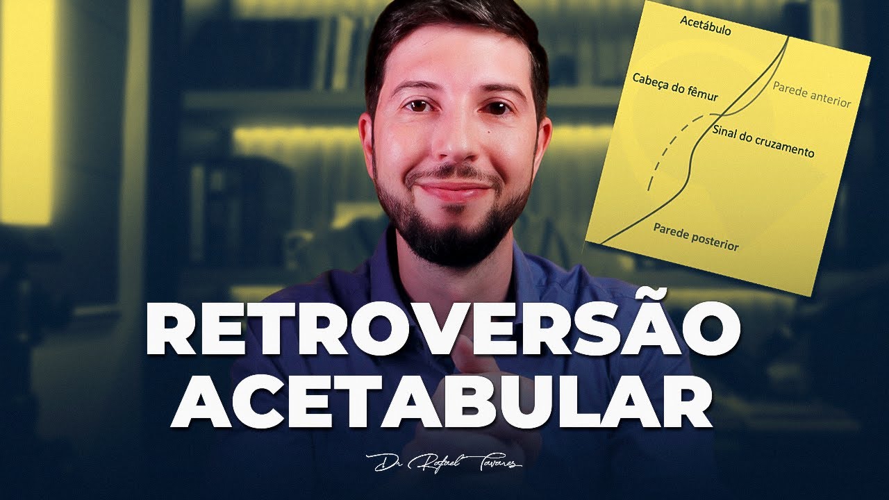 O que é a Retroversão Acetabular? #ifa #ressonância #raiox Dr Rafael Tavares - Quadril