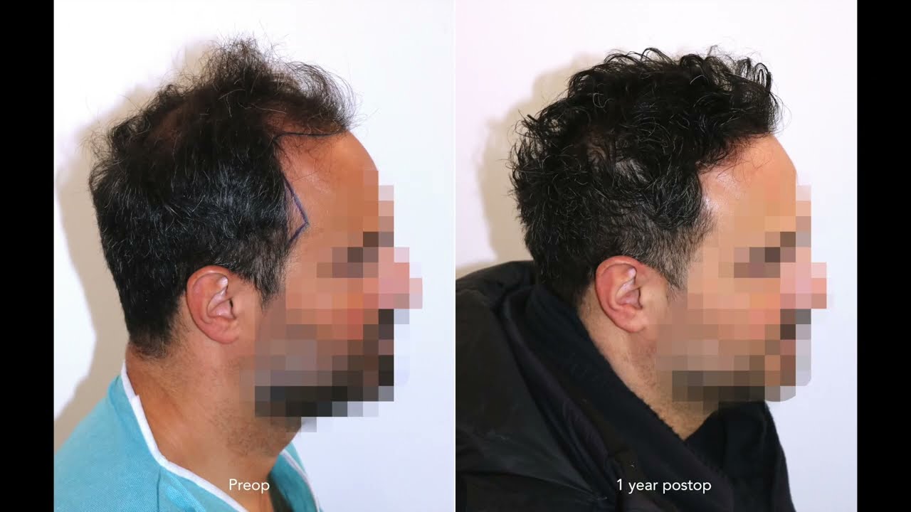 Hair Transplant Before After: Reconstruction of the Hairline & Temple points & Crown area 4485 FUs