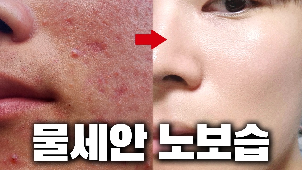 물세안 노보습 2년 후기, 장단점 ㅣ 여드름, 지루성 피부염, 모낭염