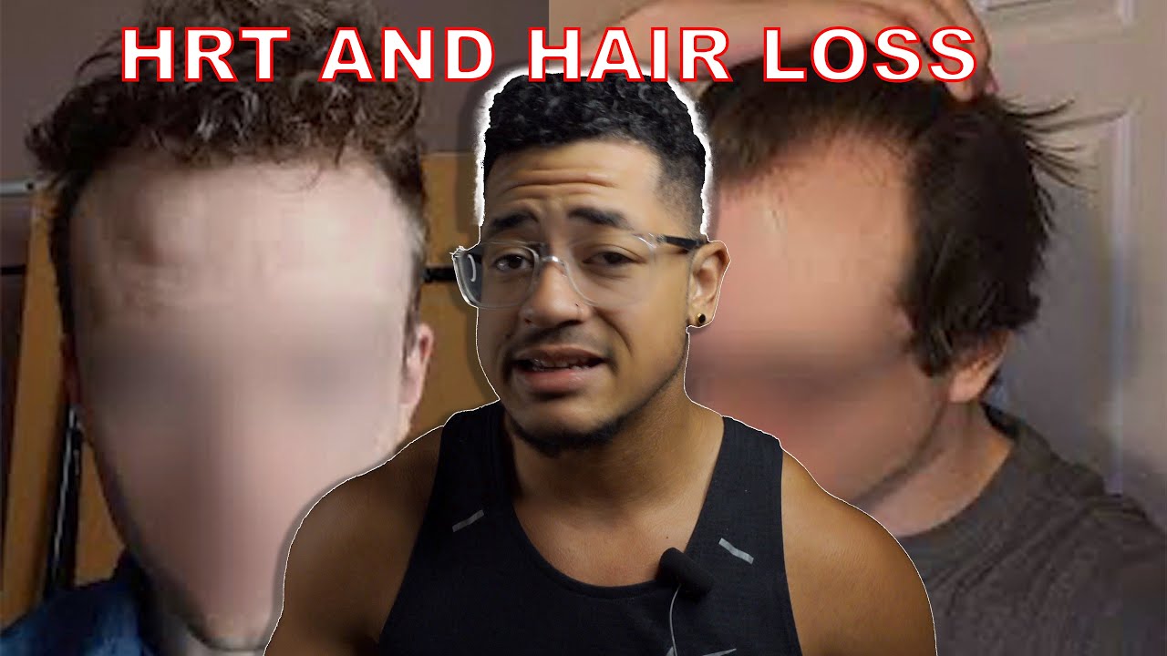 HAIR LOSS ON TESTOSTERONE | didn’t think it would happen to me either :/
