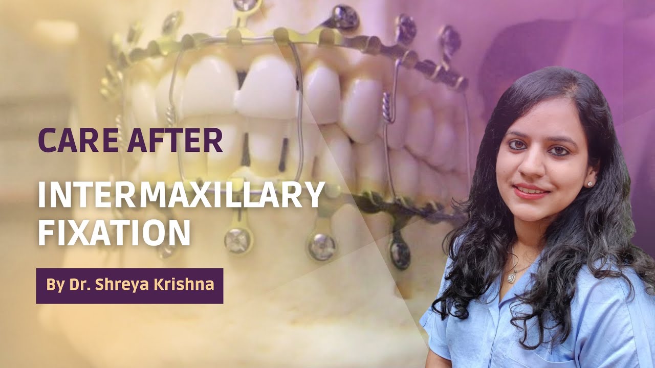 Care After Intermaxillary Fixation (IMF), Maxillomandibular Fixation (MMF) | Oral Surgeon