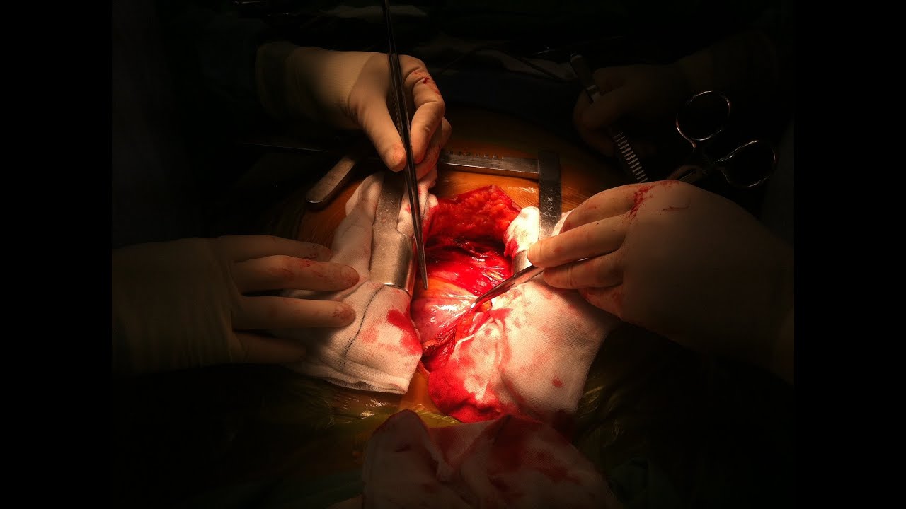 #AskDrBarai: Cardiopulmonary bypass circuit simplified I 2020