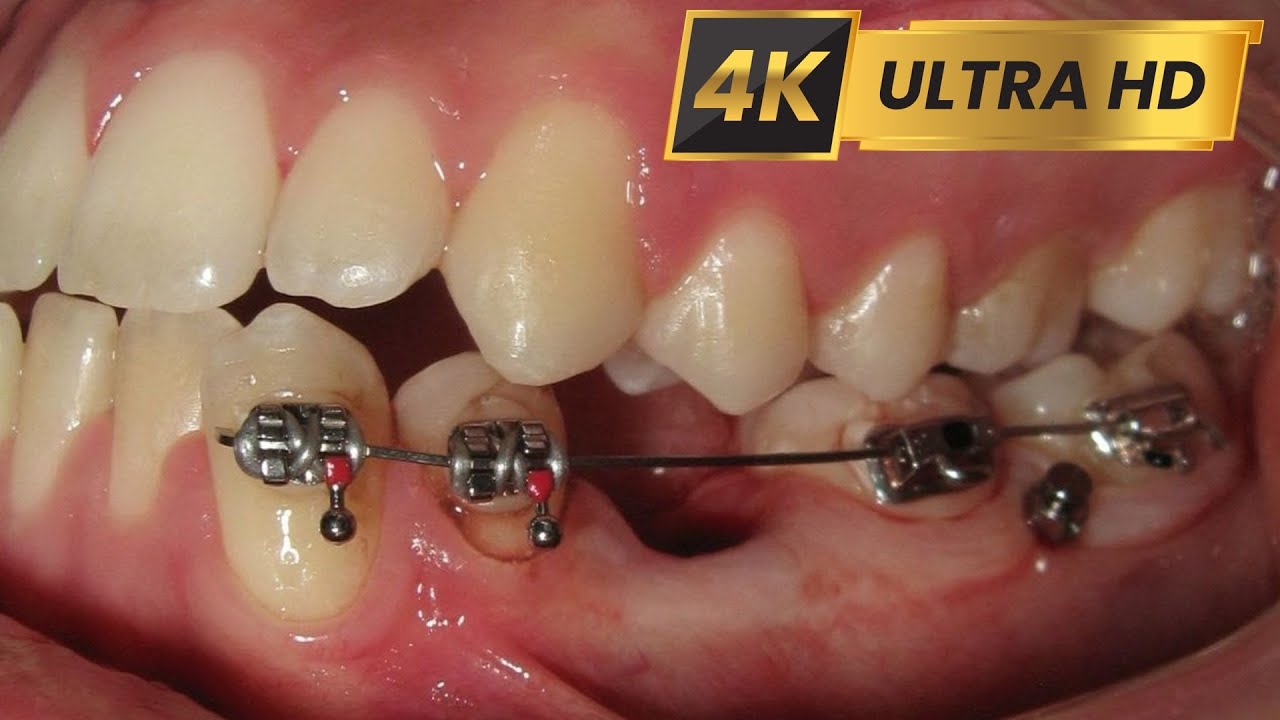 Missing tooth - premolar! HOW braces WORK! #4k