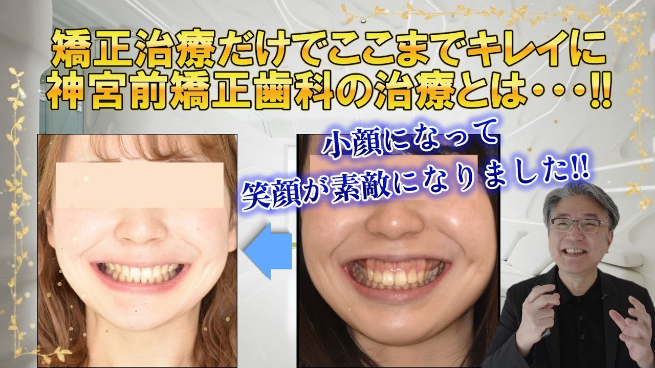 【症例解説】ガミースマイル・口ゴボ・出っ歯・面長・あごなし！　斉宮先生のアイステーション矯正×裏側矯正、オートローテーションでキレイなEラインに＾＾