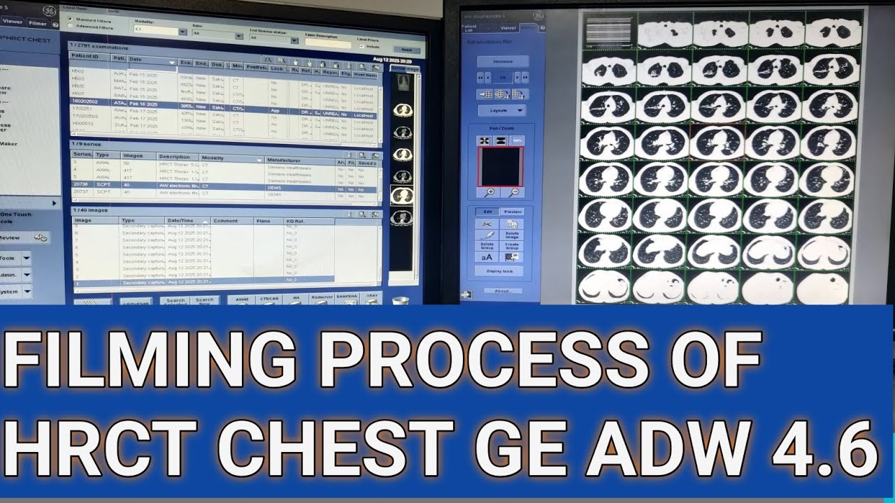 FILMING process of HRCT CHEST GE ADW 4.6 software #ct #ctscan #hrct #chest #radiology #viralvideo 