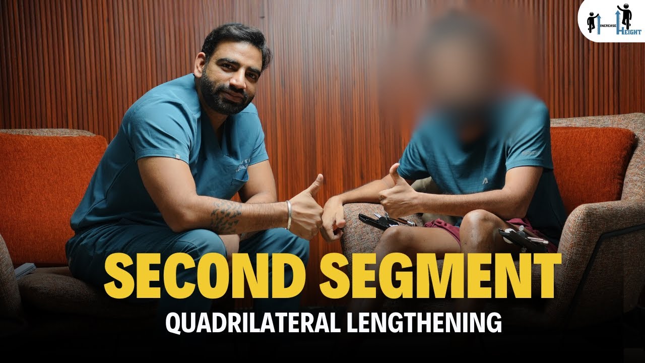 Quadrilateral Limb Lengthening Surgery Journey for Gaining 13-15 cm Height