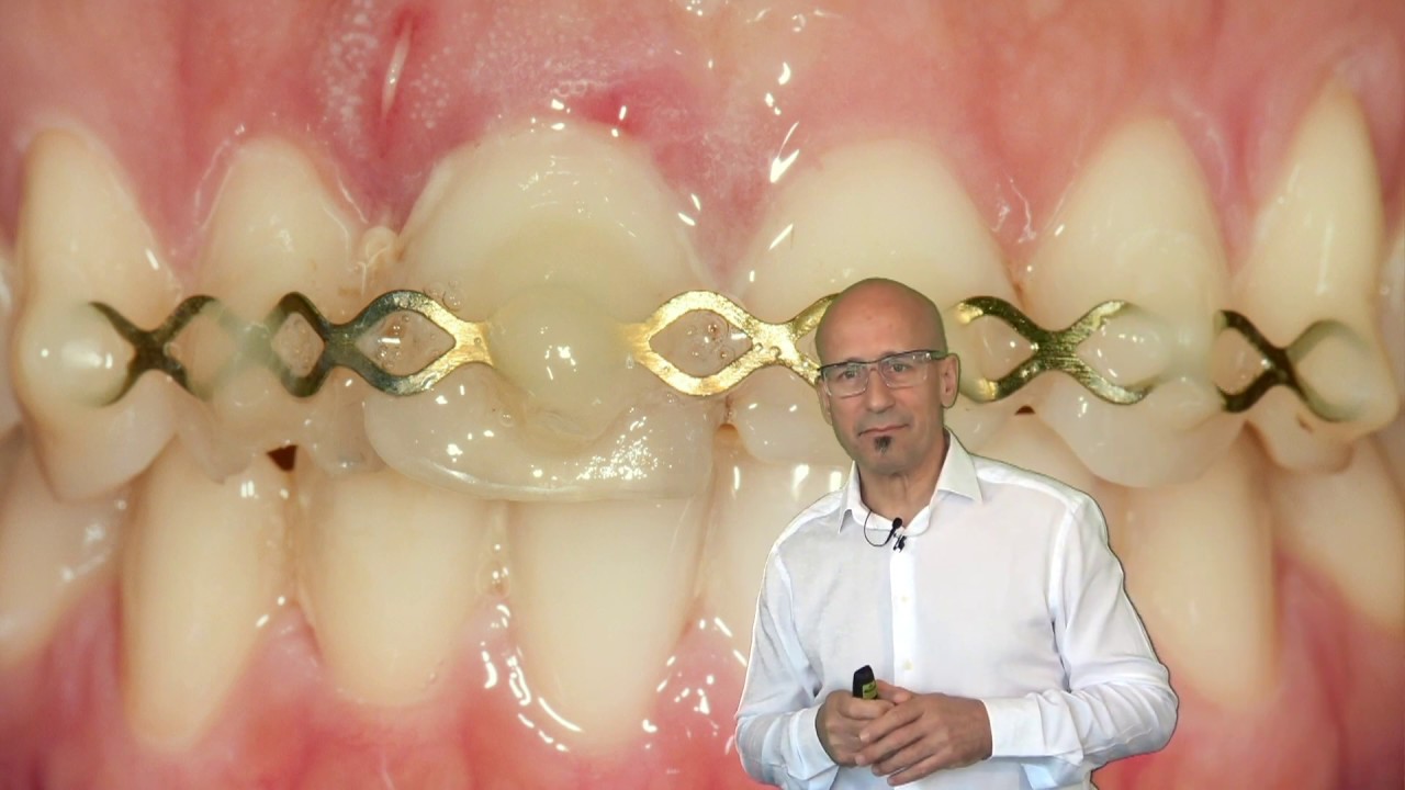 Huerzeler/Zuhr Case series 01: Problems in the Esthetic Zone