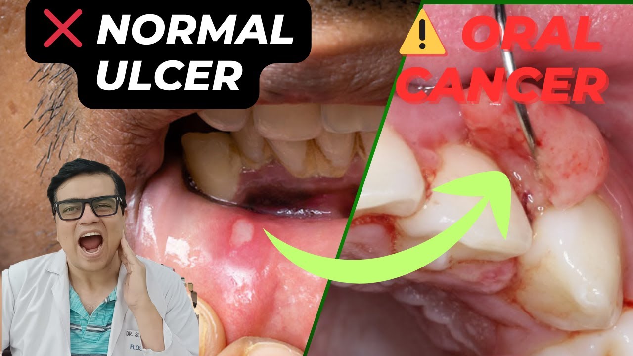 👉 Mouth Ulcer or Oral Cancer? 5 Warning Signs You Must Not Ignore