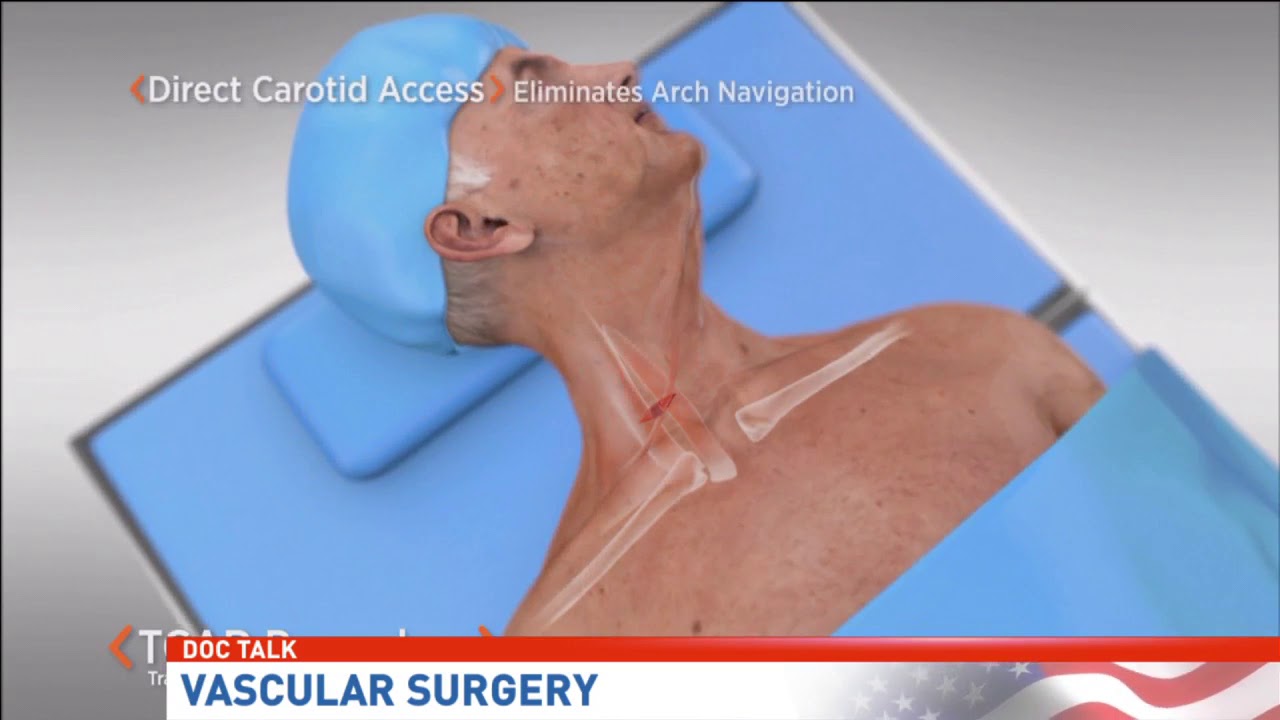 Doc Talk | New procedure for vascular surgery