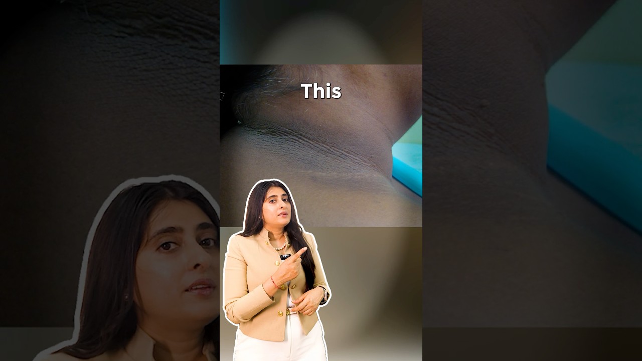 Dark neck treatment| Dark Neck| Neck Pigmentation|