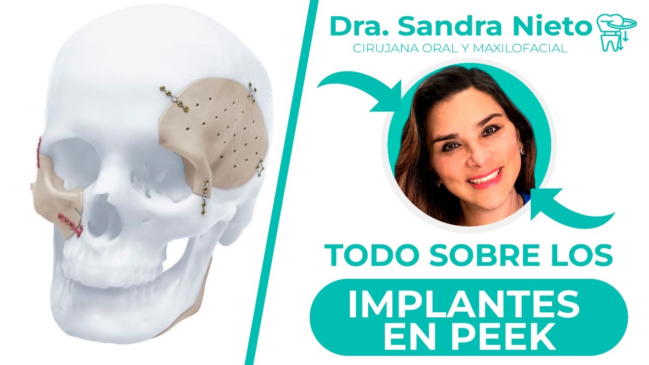 TODO SOBRE LOS IMPLANTES EN PEEK 🔥