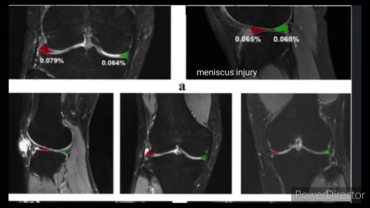 Proton Density Weighted image in MRI.