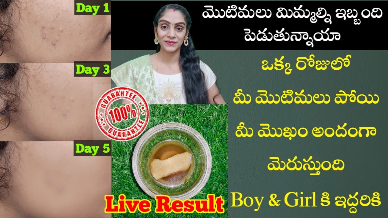 Overnight Pimples Remove In Just 1 Ingredient | Home Remedies Pimple Remove | How To Remove Pimples