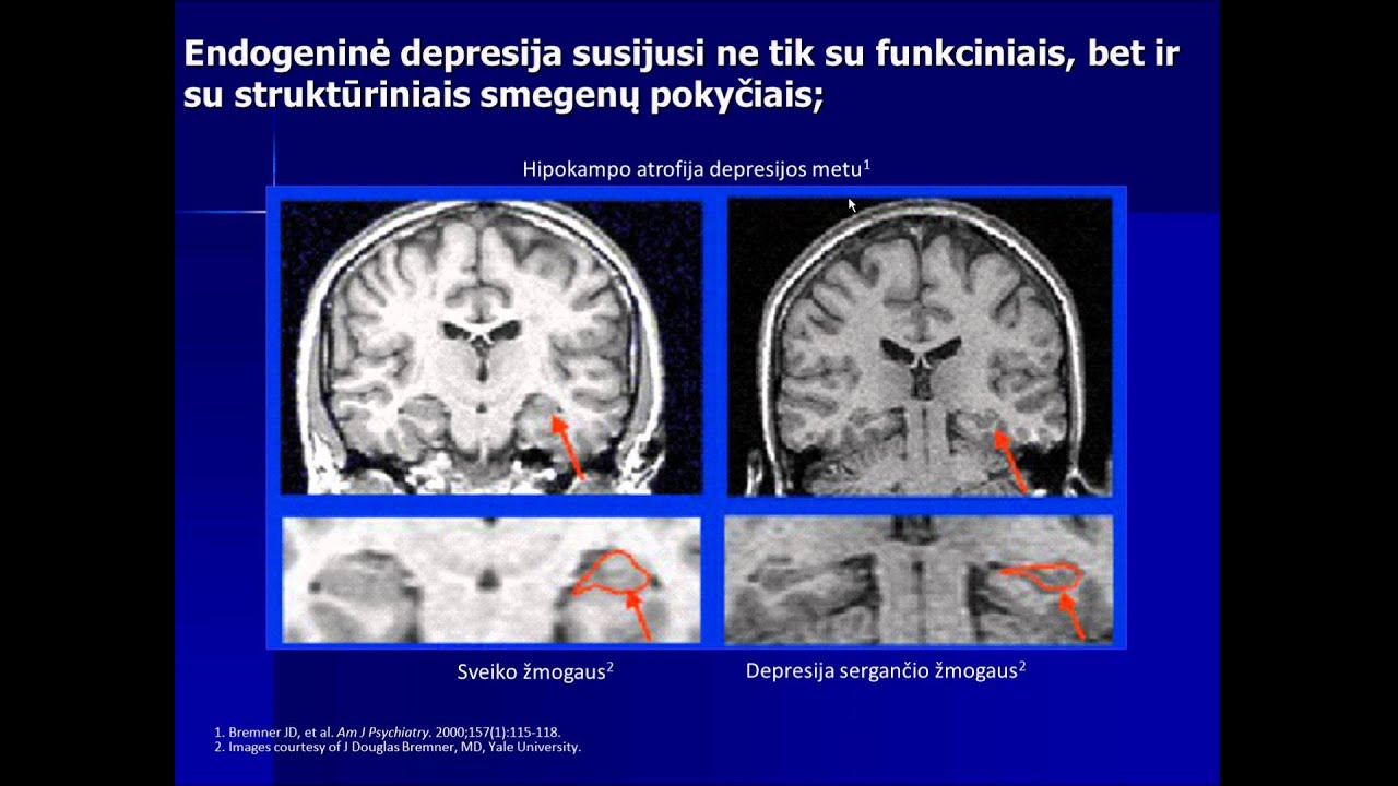 Devynioliktoji tema: Depresija. Diagnositka ir gydymas
