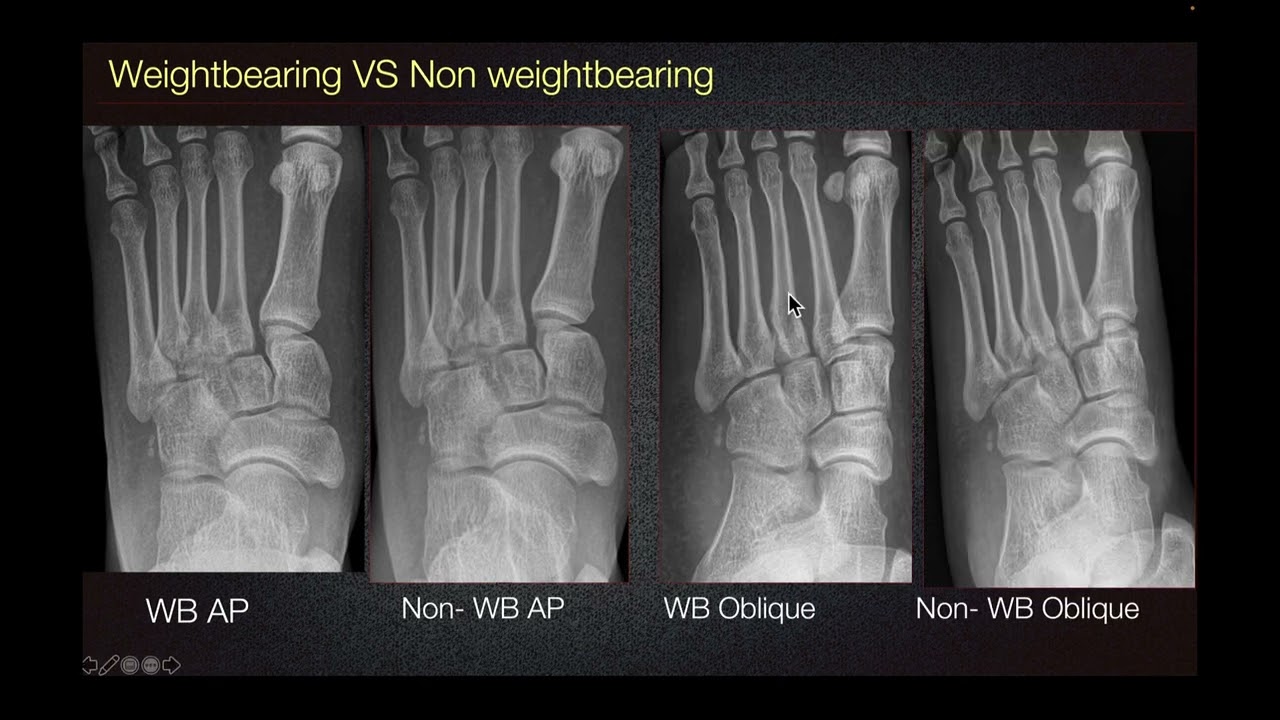 Sports Medicine Case 13: 14-year-old: Foot Pain