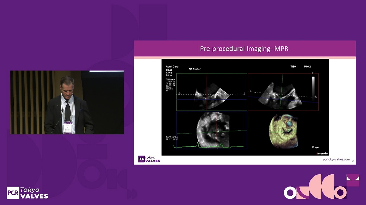 Real world outcomes and strategies for optimal TEER across diverse DMR anatomies - PCR Tokyo Valves