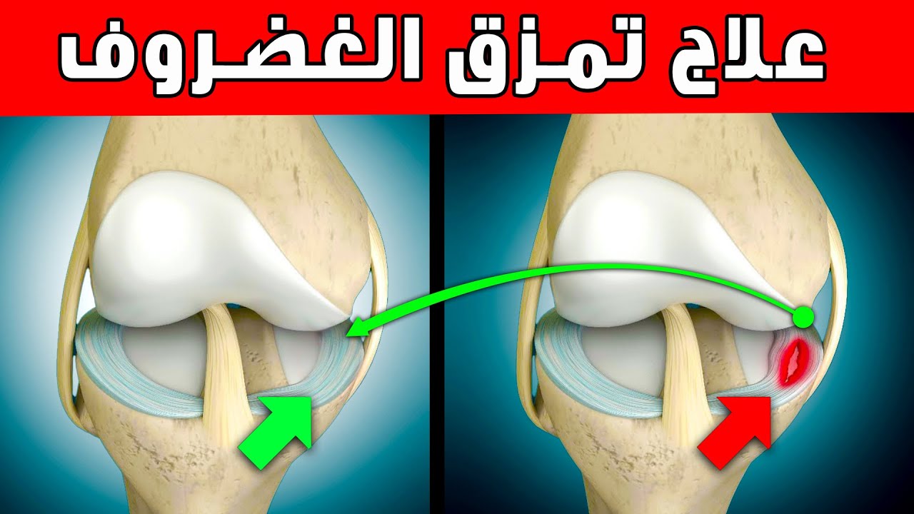 علاج مضمون ١٠٠% تمزق غضروف الركبه الهلالي | انسى الم المشي والدرج، السجود، قفل الركبه