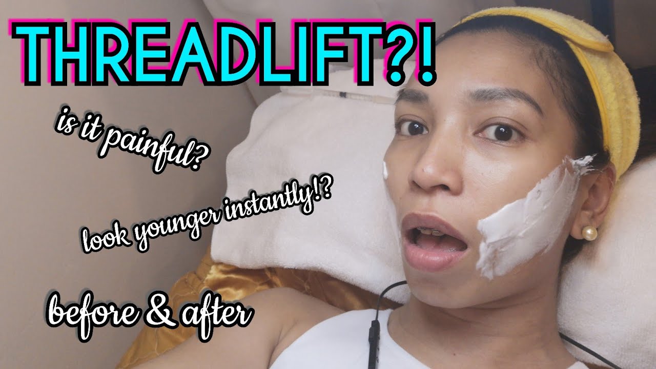 I HAD A NON-SURGICAL FACE LIFT! | PDO Thread Lift BEFORE & AFTER