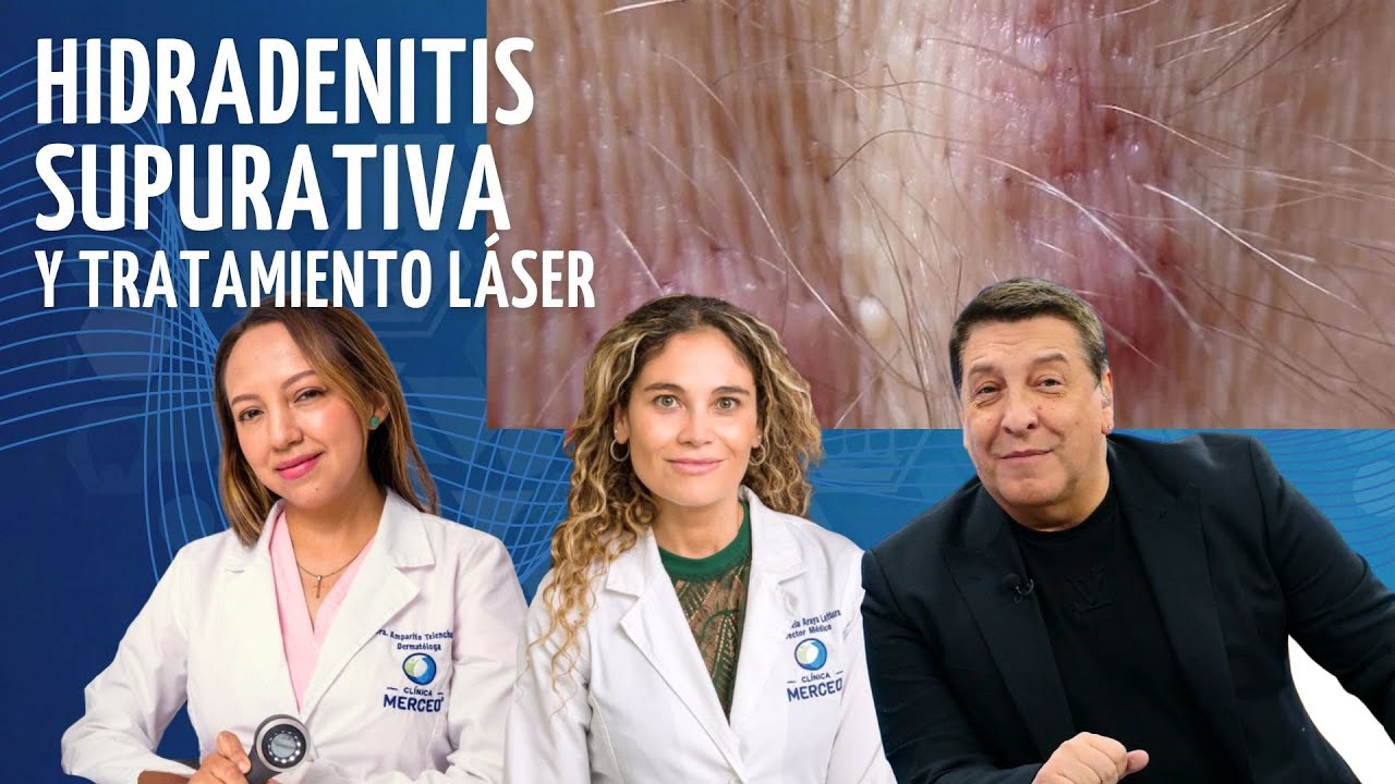 Hidradenitis Supurativa y Tratamiento Láser: Soluciones Médicas Efectivas Clínica Merced 👩‍⚕️👨‍⚕️