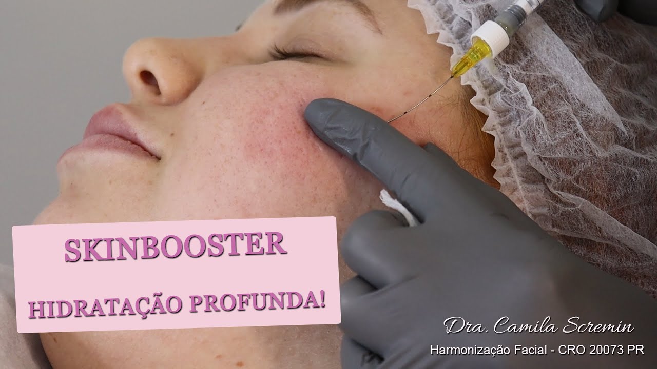 Tratamento para cicatriz de acne e hidratação da pele! Skinbooster - Pele Seca - Pele Hidratada