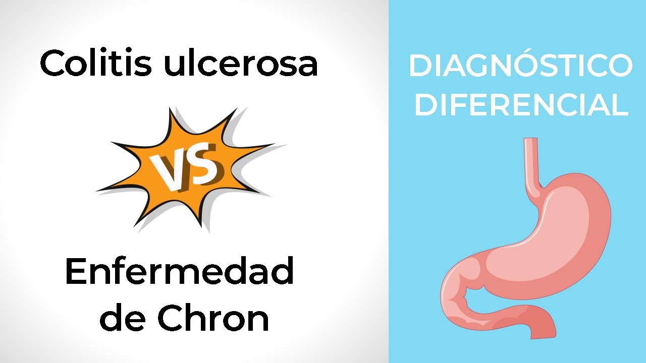 Diagnóstico Diferencial. Colitis ulcerosa vs Crohn