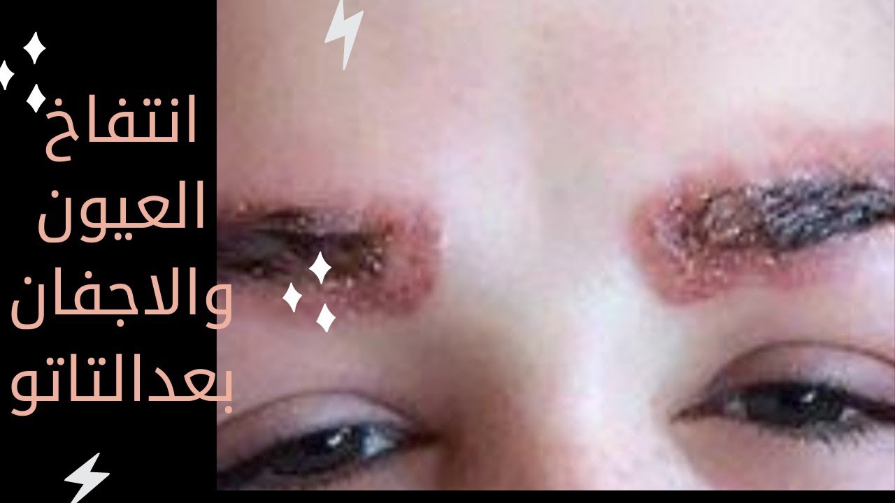 ورم الاجفان والعيون اثناء عمل التاتو...السبب ..العلاج.Swollen eyes after tattoo    ￼