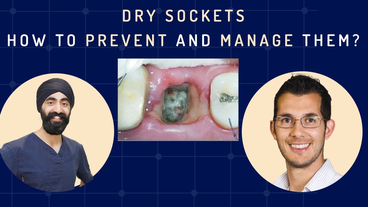 Dry Sockets - How to Prevent and Manage Them? Oral Surgery Complications - GF010