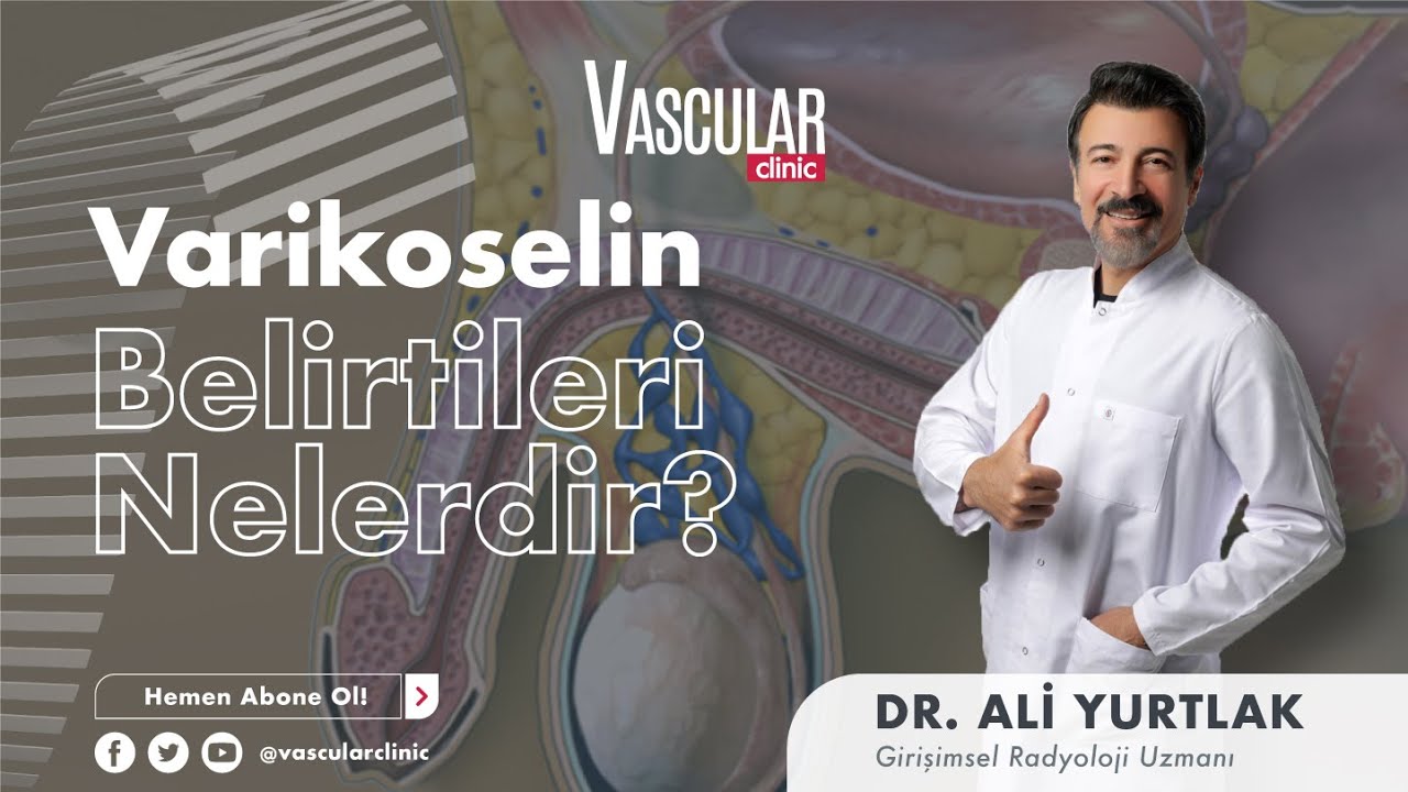 Varikoselin Belirtileri Nelerdir?