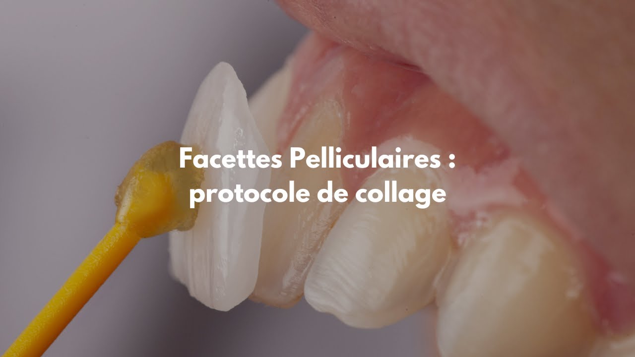 Facettes pelliculaires : Protocole de collage