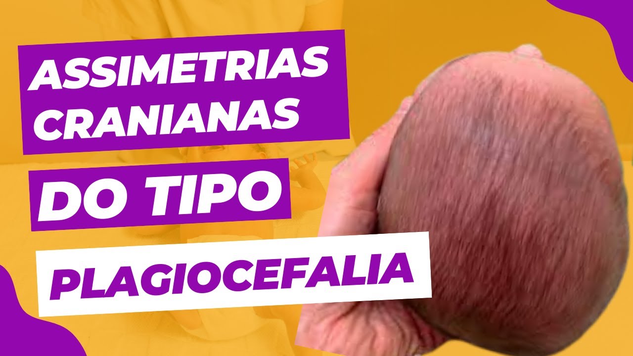 O que causa assimetria craniana - Identificar uma assimetria craniana - O que é assimetria craniana?