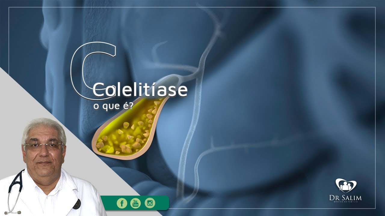 Colelit&iacute;ase, voc&ecirc; sabe o que &eacute;? | Dr. Salim CRM 43.163