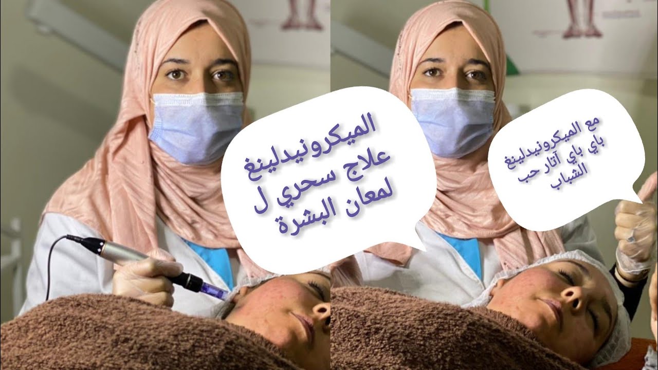 الميكرونيدلينغ أو الديرمابن خدمتها لزبونتي عطاتها نتيجة فعالة 💯في إزالة آثار حب الشباب و البقع