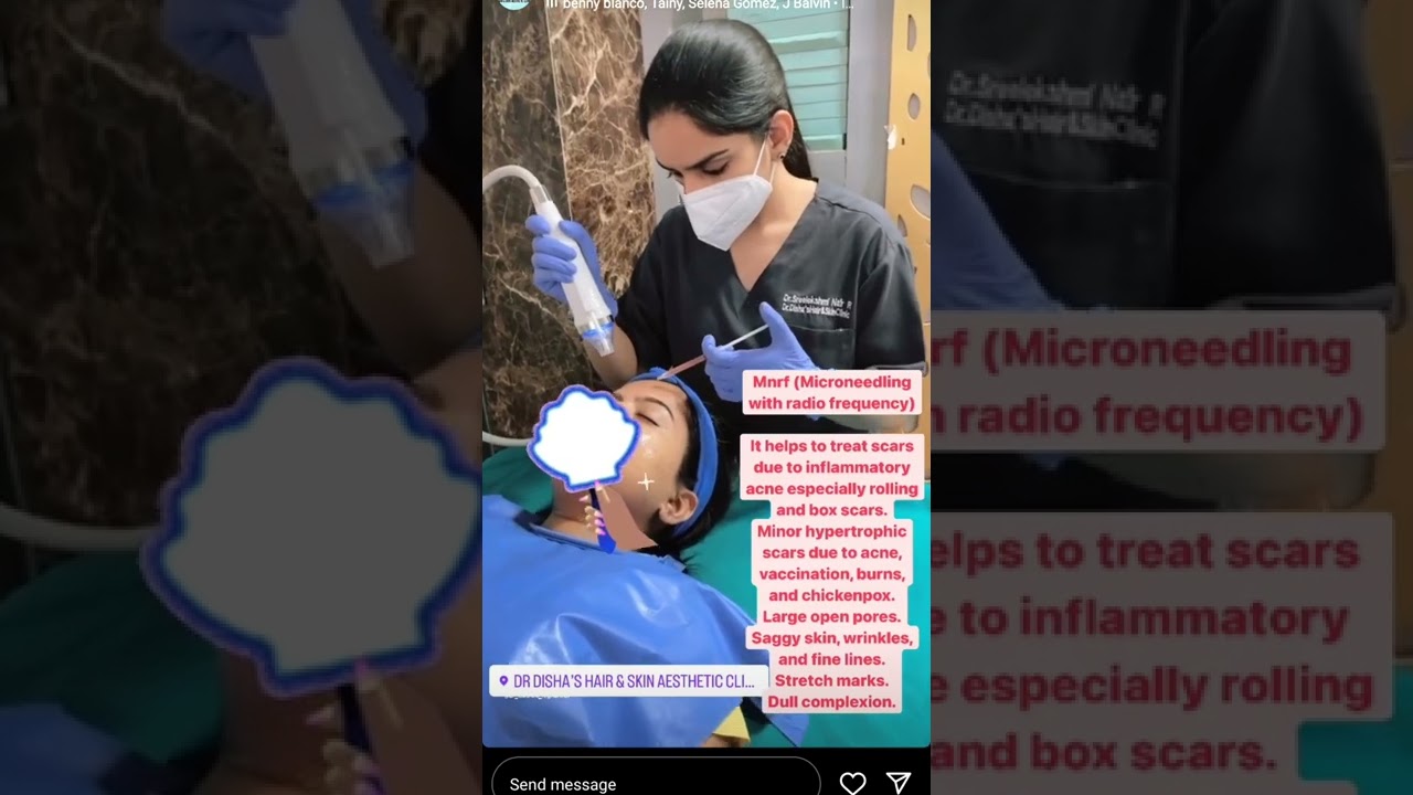 MNRF/MICRONEEDLING