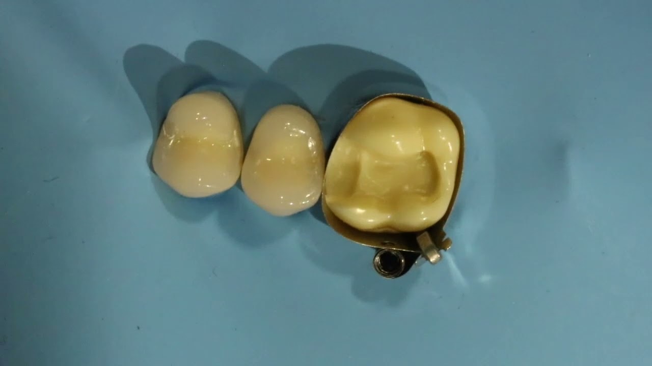 technique du relais crampon matrice