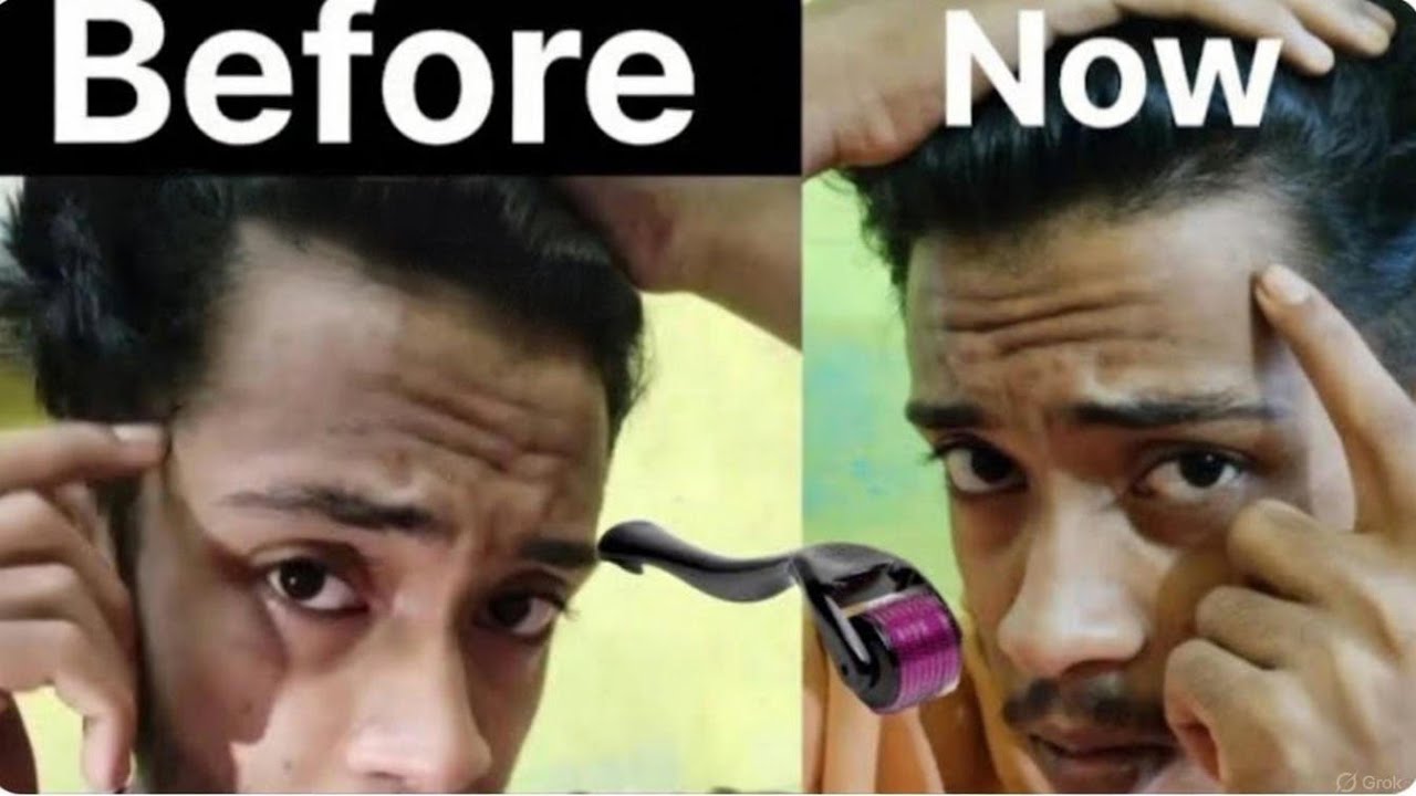 I Have Regrowed My Hair Line In 1 Month With Derma Roller . ( REGROW YOUR HAIRLINE IN 1 MONTH ) Pt.2