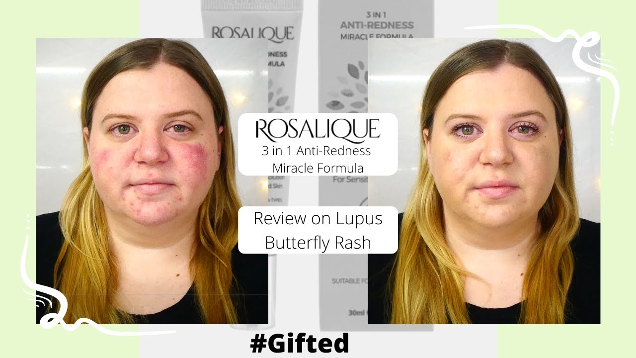 Rosalique 3 in 1 Anti-Redness Miracle Formula Review on Lupus Butterfly Rash || Beth Does Beauty