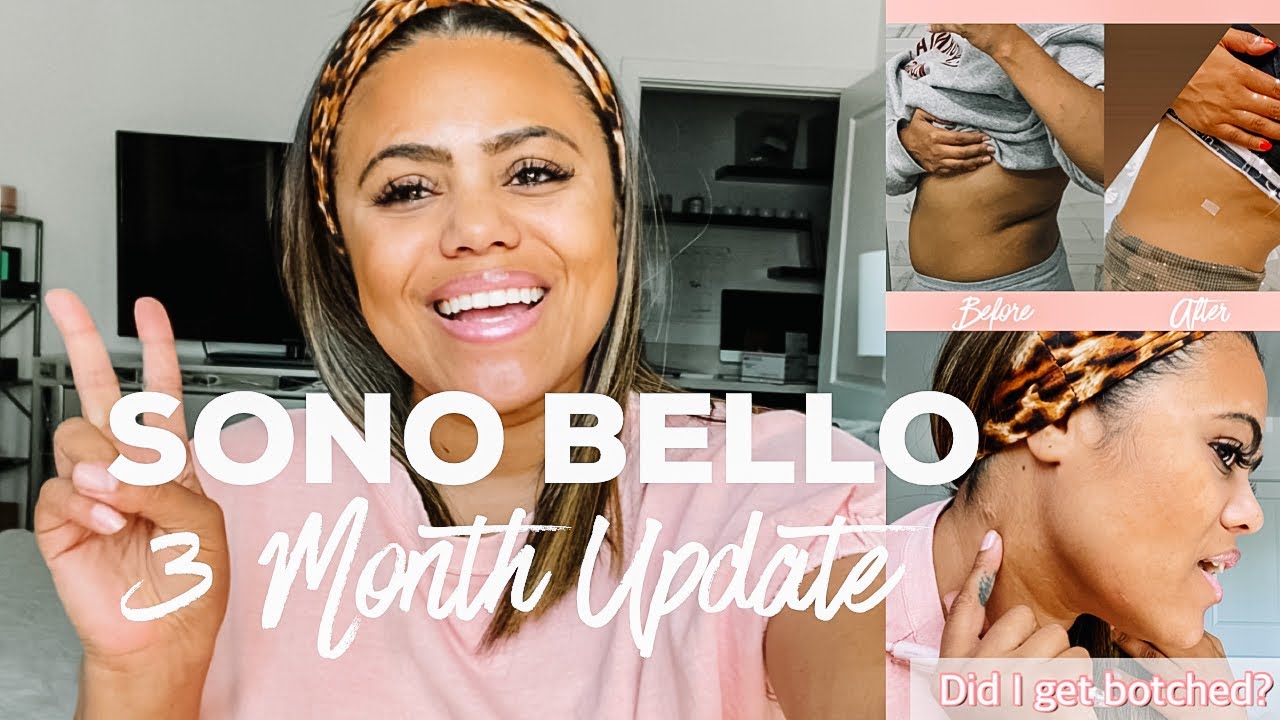 MY SMART LIPO EXPERIENCE WITH SONO BELLO PT2! [3 MONTHS POST OP!]